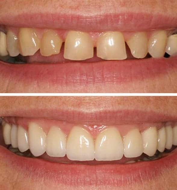 Smile Makeover